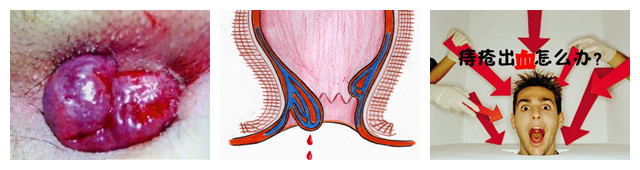 血栓外痔