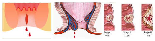 肛门出血是什么原因