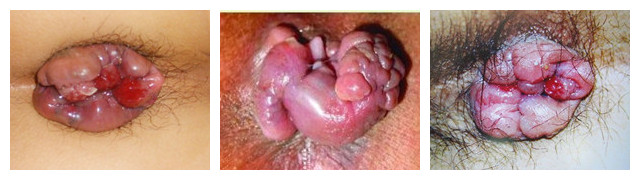 痔疮症状有哪些?