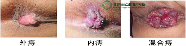 痔疮是怎么回事
