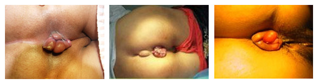 痔疮的症状有哪些?