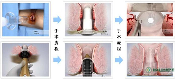痔疮的较佳治疗方法是什么