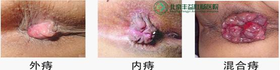 内痔、外痔、混合痔症状