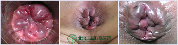 痔疮症状
