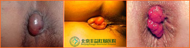痔疮症状