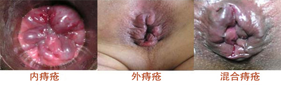 三大痔疮的类型