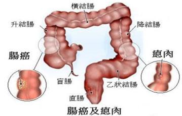 大肠癌